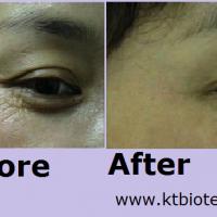 Large picture EGF clinical pic ( anti aging repairing )
