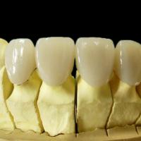 Large picture Dental Porcelain Cobalt-Chrome alloy crown
